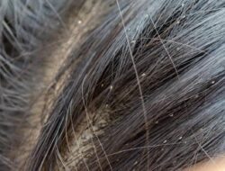Cara Mengatasi Kutu Rambut yang Menjengkelkan