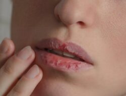 Tips untuk Menghilangkan Bibir Pecah-pecah
