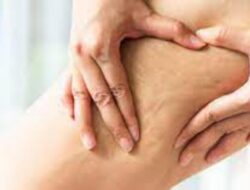 3 Makanan yang Dapat Picu Timbulnya Selulit