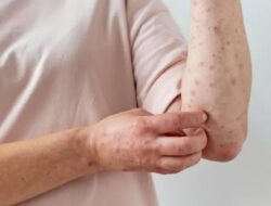 Kenali Ciri-ciri Kulit Penderita HIV yang Penting Diketahui