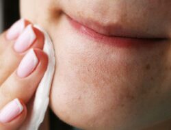 Berikut Cara Alami Menghilangkan Komedo dengan Bahan Rumahan