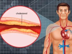 Cara Mencegah Kolesterol Tinggi yang Memicu Serangan Jantung