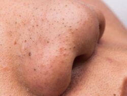 3 Cara Menghilangkan Komedo dengan Bahan Alami