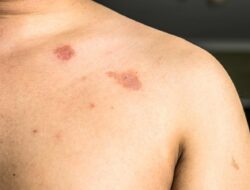 Infeksi Jamur di Tubuh Tak Kunjung Hilang? Mungkin Ini Alasannya