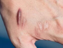 Cara Menghilangkan Keloid Secara Alami, Mudah dan Aman Dilakukan