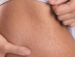 Stretchmarks di Kulit Dapat Hilang dengan Bahan Ini, Penasaran? Simak Disini!