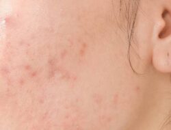 Catat! Ini Cara Mengatasi Jerawat Meradang di Pipi