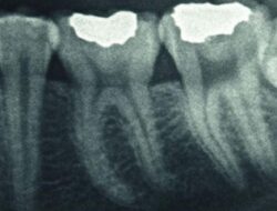 Gigi Bengkok: Penyebab, Dampak, dan Pengobatannya