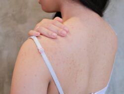 Tips Merawat Kulit dan Mengatasi Jerawat di Punggung