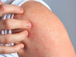 Obat Alami untuk Menghilangkan Bekas Cacar Air, Bahannya Mudah Didapat