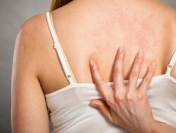 Tips Mudah Untuk Menghilangkan Jerawat Punggung