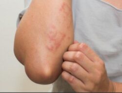 Sedang Alergi? Mungkin Ini Penyebabnya!