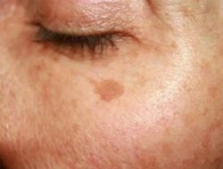 Dapatkan Kulit Terbaikmu, Begini Mengatasi Jerawat dan Flek