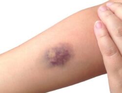 Cara Mengobati Memar di Tubuh dengan Mudah