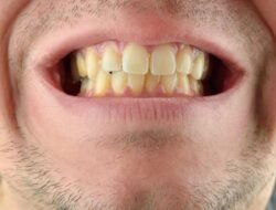 Tips Sederhana Menghindari Noda Gigi Akibat Kopi