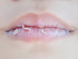 Gunakan Pengobatan Rumahan Ini untuk Bibir Pecah-pecah!