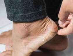 Pengobatan Rumahan untuk Kaki Kering dan Pecah-pecah