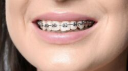 Tips Merawat Gigi yang Memakai Behel