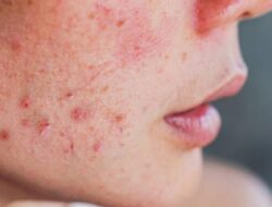 Tips Merawat Kulit Sensitif Ala Aveeno yang Perlu Kita Tahu