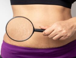 11 Cara Menghilangkan Stretch Mark yang Perlu Anda Ketahui