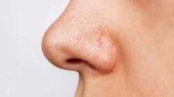 Tips Hilangkan Komedo Hitam di Hidung