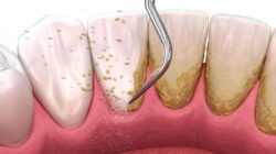 Ikuti Tips Ini Agar Plak dan Karang Gigi Bisa Hilang!