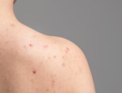 Cara Menghilangkan Jerawat di Bahu: 5 Pengobatan Rumahan Ini Patut Dicoba