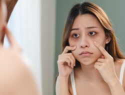 Pigmentasi di Bawah Mata: Berikut Ini 5 Solusi Rumahan untuk Mengatasi Perubahan Warna Kulit
