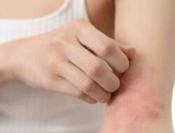 Mengatasi Biang Keringat: Cobalah Manfaat Mendinginkan dari Minyak Kelapa