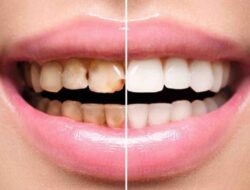 Ucapkan Selamat Tinggal pada Gigi Kuning dengan Kiat-kiat Penghilang Karang Gigi Ini!
