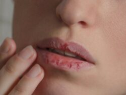 Jika Bibir Kering Membuat Anda Mimpi Buruk, Berikut 4 Pengobatan Rumahan yang Harus Dicoba