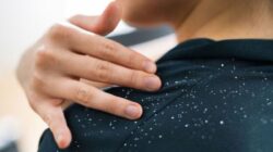 Hilangkan Ketombe dengan Menggunakan Masker Rambut DIY dari Yogurt dan Triphala Dua Kali Seminggu