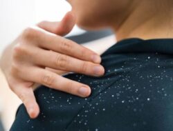 Hilangkan Ketombe dengan Menggunakan Masker Rambut DIY dari Yogurt dan Triphala Dua Kali Seminggu