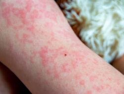 Hingga Maret 2026, Muncul Tiga Kasus Campak di Sukoharjo, Dua Diantaraya Bayi