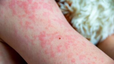 Hingga Maret 2026, Muncul Tiga Kasus Campak di Sukoharjo, Dua Diantaraya Bayi