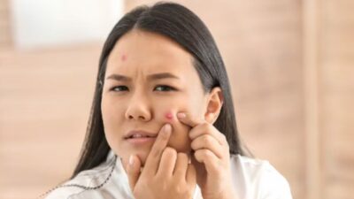 Berjuang Melawan Jerawat? Percayalah pada 5 Pengobatan Rumahan Terbaik untuk Jerawat Ini