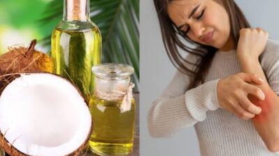 Minyak Kelapa: Apakah Ini Pengobatan Rumahan yang Efektif untuk Psoriasis? Ini Penjelasannya