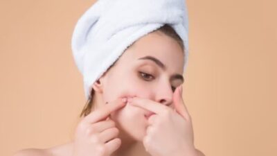 Bingung Menghilangkan Komedo di Pipi? Cobalah 5 Cara Alami yang Mudah Ini