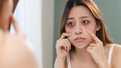 5 Cara Alami Mengatasi Pigmentasi di Bawah Mata, Ternyata Mudah!
