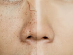 Tips Mengatasi Kulit Kusam Akibat Sinar Matahari dan Hiperpigmentasi dengan 6 Cara Mudah Ini