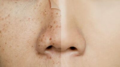 Tips Mengatasi Kulit Kusam Akibat Sinar Matahari dan Hiperpigmentasi dengan 6 Cara Mudah Ini
