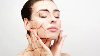 Berikut Ini 7 Cara Alami Mengatasi Kulit Kering yang Mengelupas